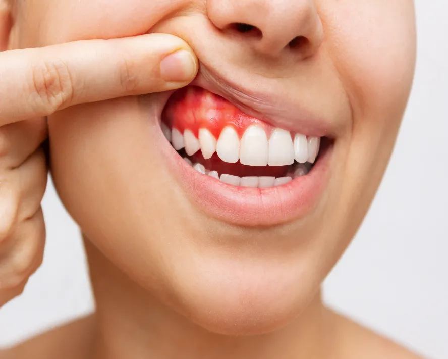 Periodontics (Gum Treatment)