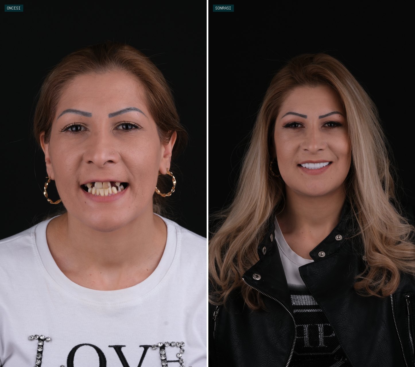 Bağcılar Diş öncesi sonrası
