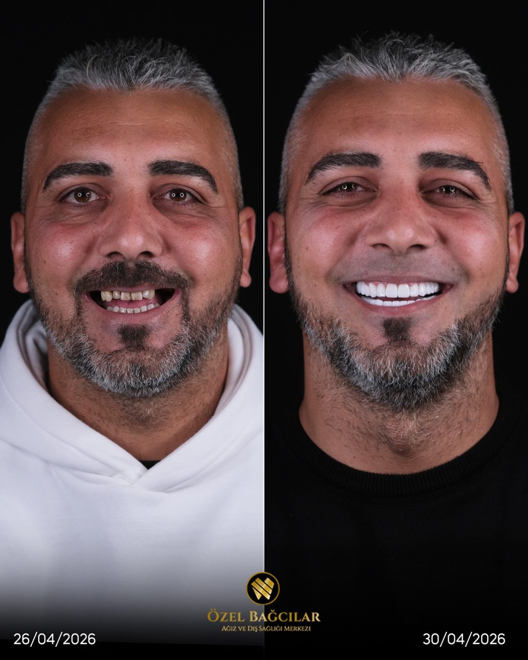 Bağcılar Diş öncesi sonrası