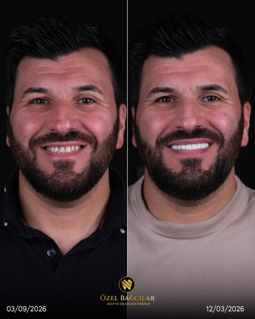 Bağcılar Diş öncesi sonrası