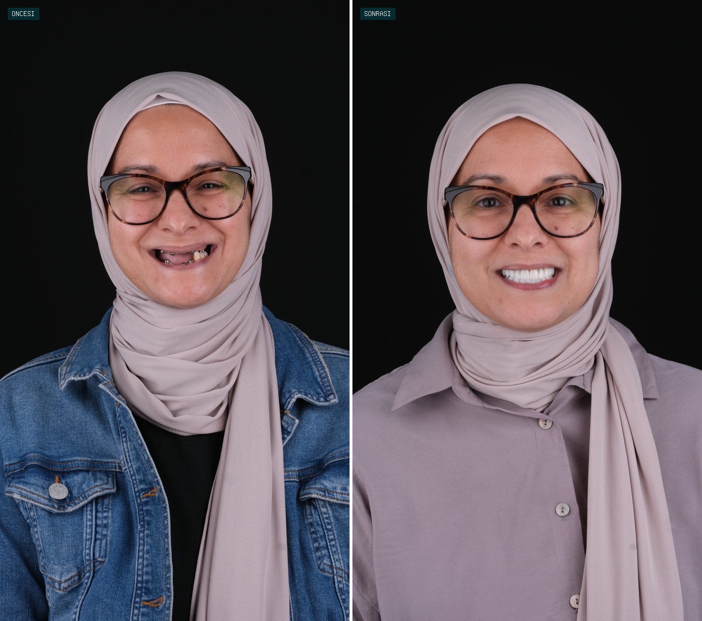 Bağcılar Diş öncesi sonrası